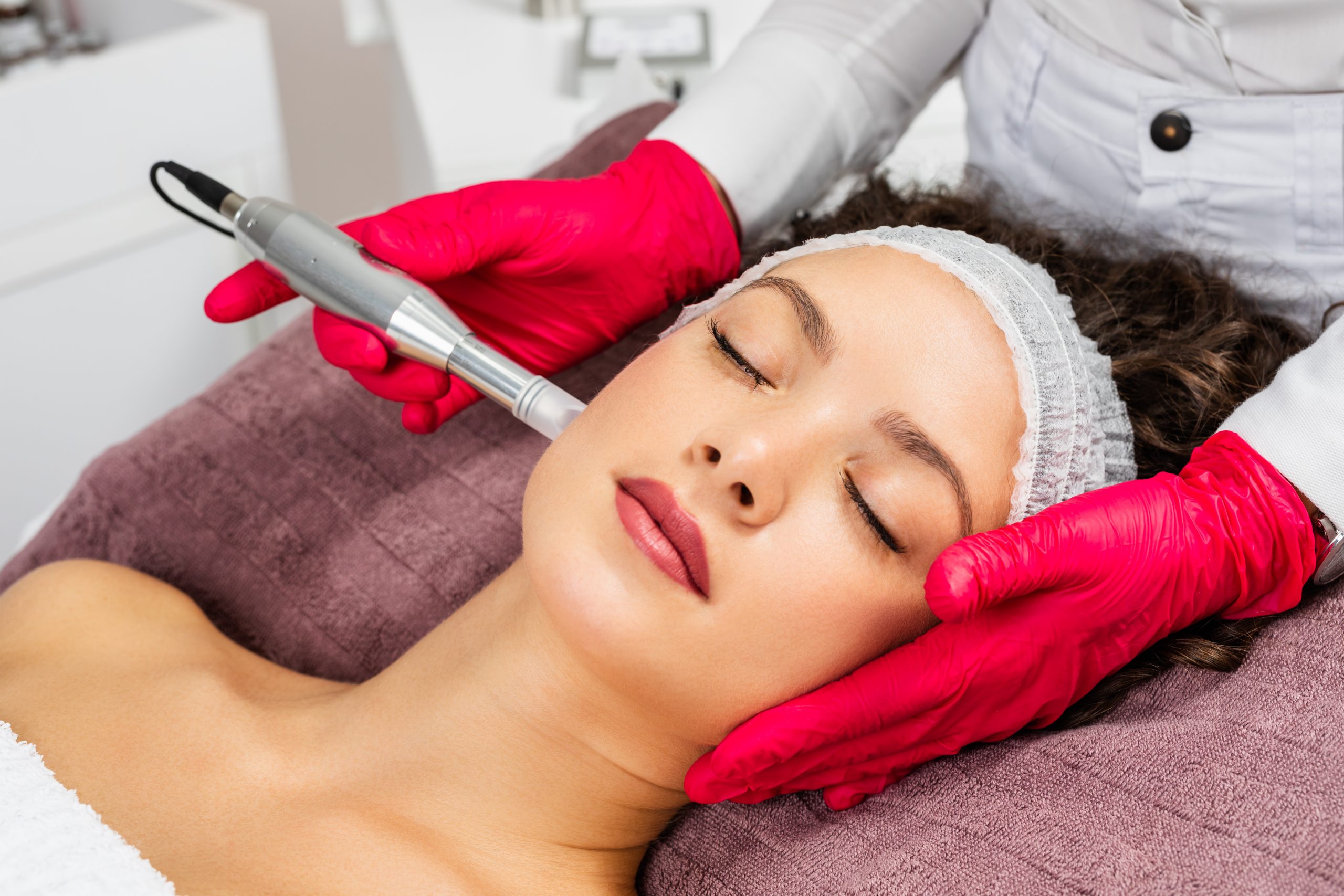 how many microneedling sessions for acne scars