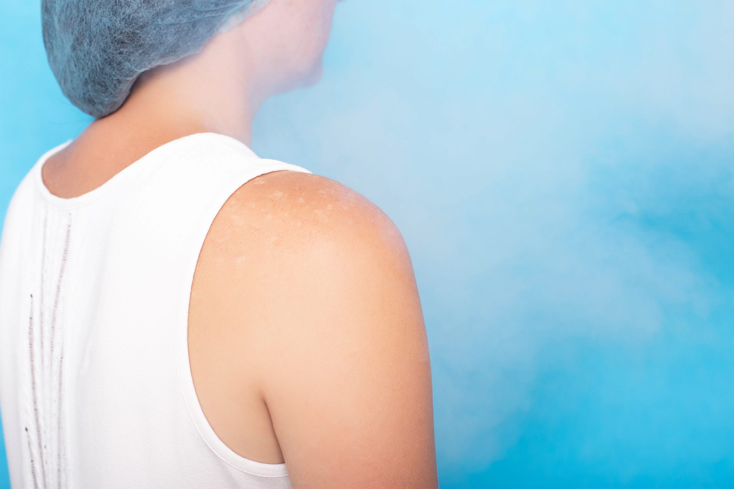 what to expect after cryotherapy